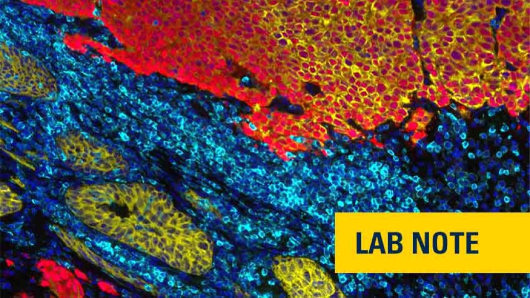 prostate cancer cells in blue green and orange in a microscope view with badge on bottom right saying lab note in yellow and navy blue