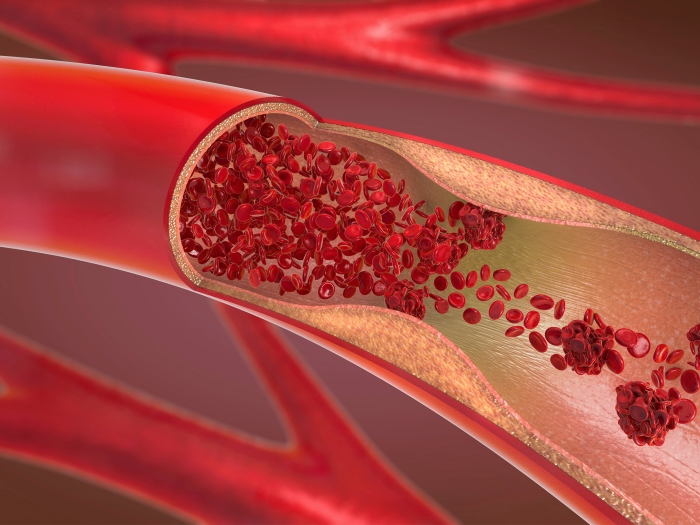 Vein-Red-Blood-Cells-Plaque.jpg