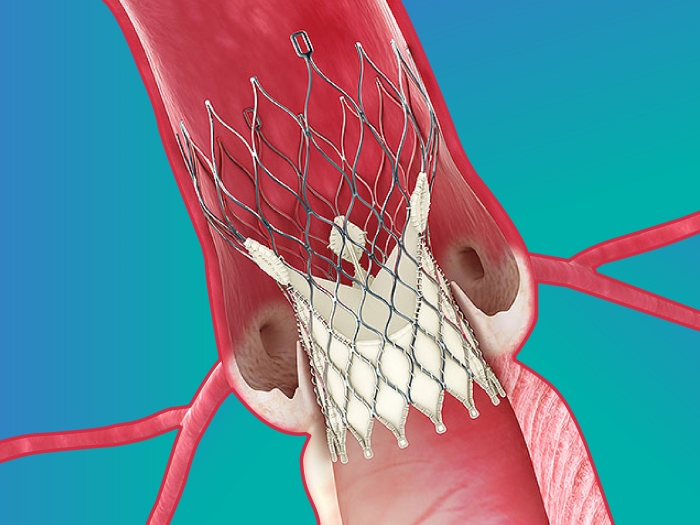 tavr stroke blue cardiovascular red inside blue background