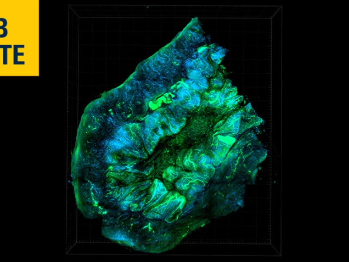ovarian cancer tumor under microscope lab note