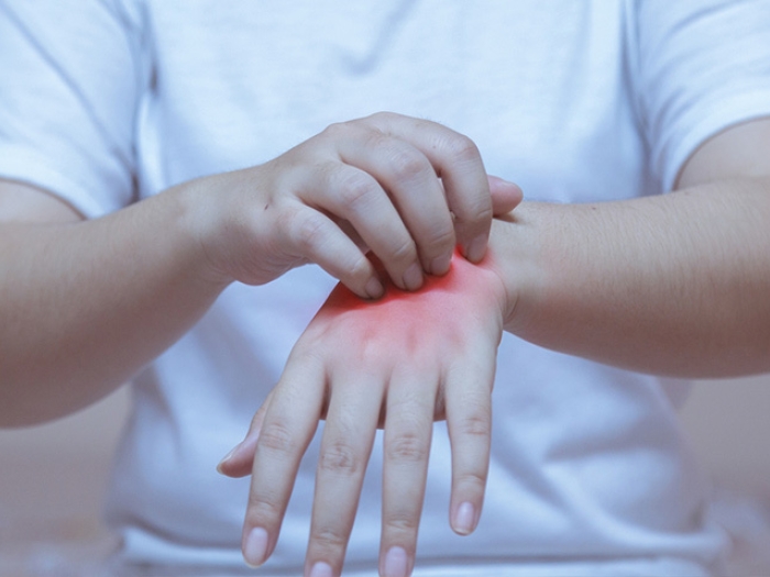 hands scratching wrist inflammation red