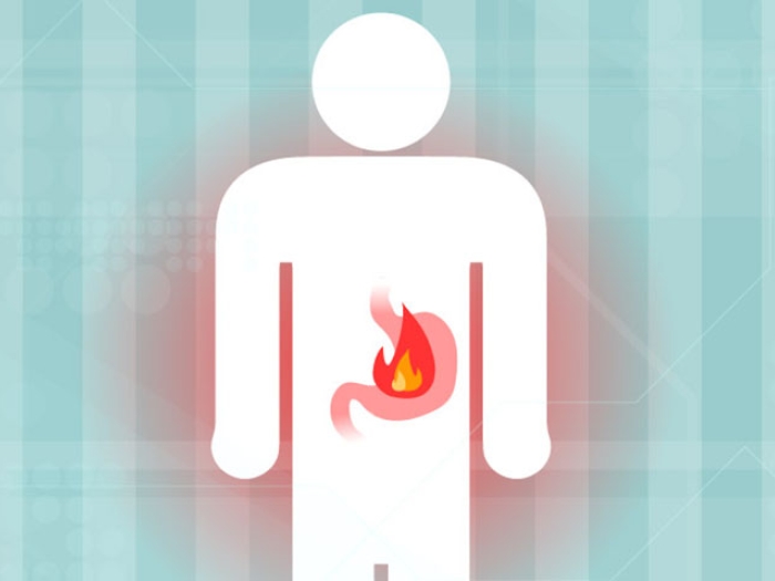 Heartburn image
