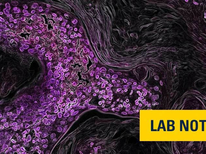 cancer cell in lung that's purple in microscopic view