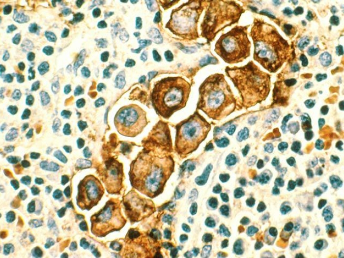 lymph nodes breast cancer under microscope 
