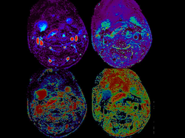 MRI perfusion flap scan highlight