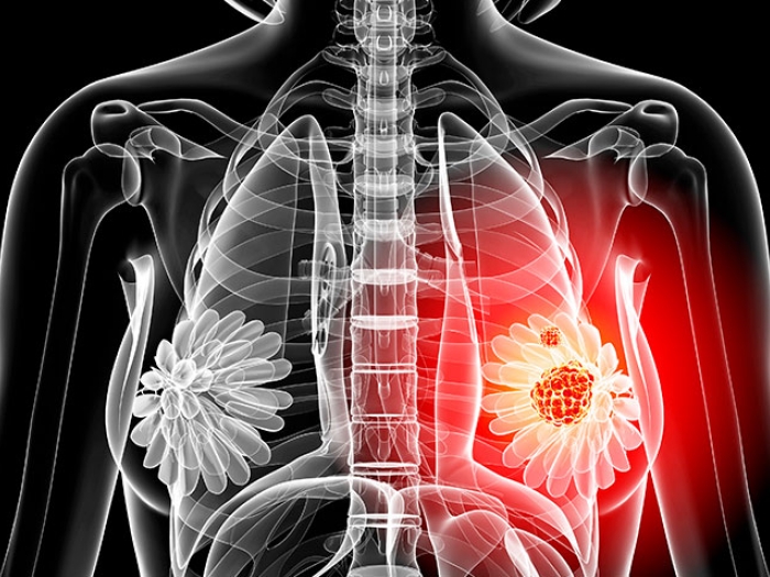 Graphic of skeleton with red radiating from left breast area