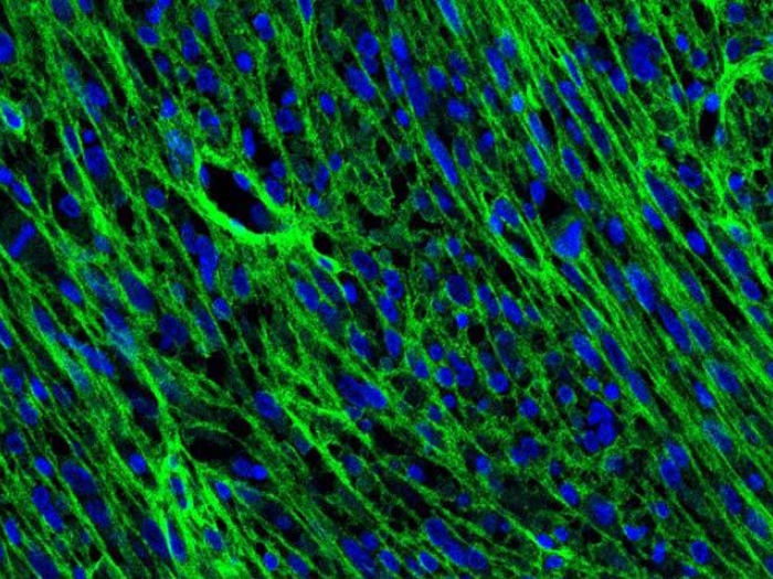 microscopic collagen tumor green blue