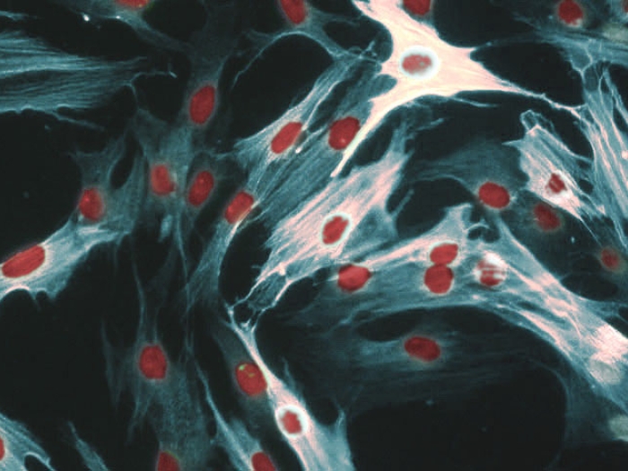 Muscle fiber microscopic scleroderma fibrosis