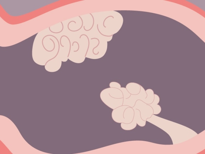 pink intestine with polyps growing graphic illustration