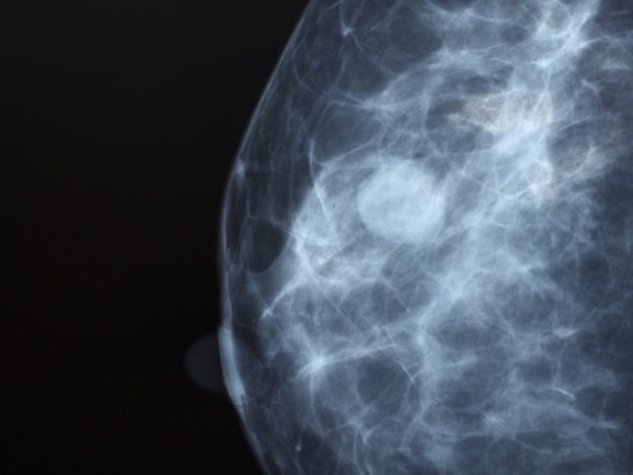 Ultrasound of dense breast tissue