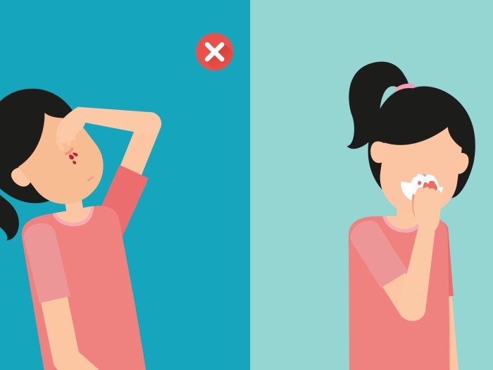 To stop a bloody nose, lean forward, not backward.