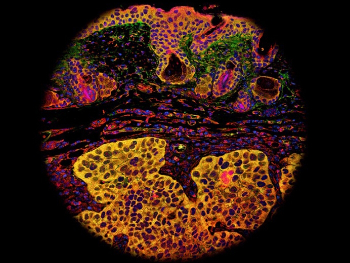 Details of a cancer tumor cell under the microscope
