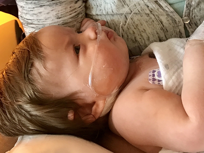 Four month old Nina after open heart surgery to treat tetralogy of fallot