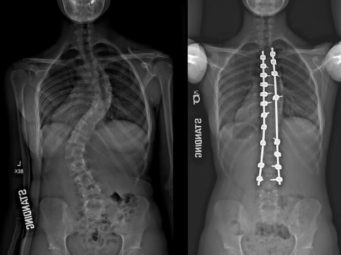 Xray image comparison of spine.