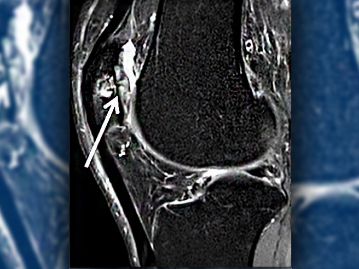 Ultrasound image of knee sag cartilage