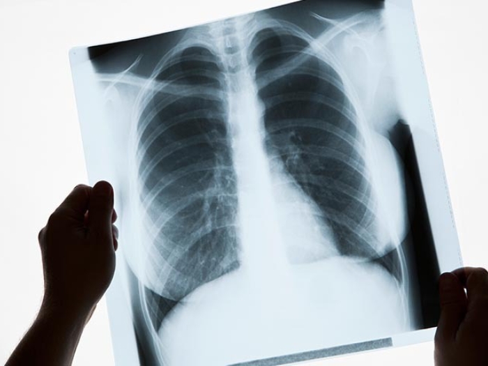 image of x-ray of lungs, two hands holding it
